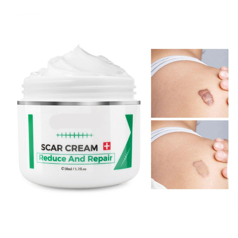 Stretch Marks Remover Cream